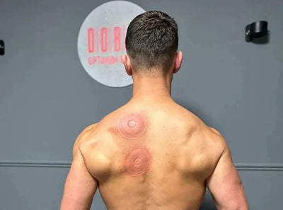 Man's back showing dynamic cupping therapy marks after SmartCup treatment for muscle relief and recovery.
